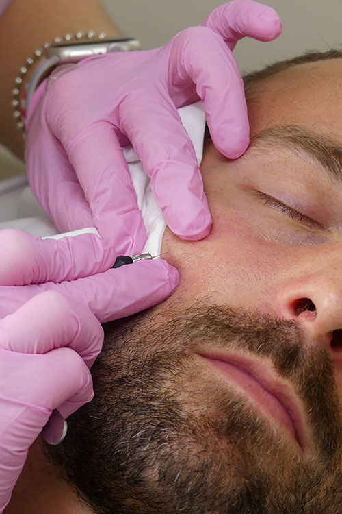 Épilation définitive pour un contour de barbe soigné dans les Landes, par le Centre de Soins Déborah-L, à 10 minutes de Dax
